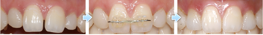 金属と樹脂の詰め物の下にできた虫歯を取り除き、セラミックの詰め物を入れた症例