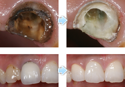 金属と樹脂の詰め物の下にできた虫歯を取り除き、セラミックの詰め物を入れた症例
